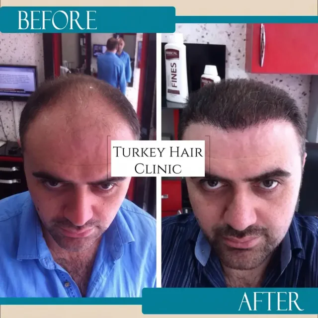 Hair transplant before and after collage — Turkey Hair Clinic, result 2