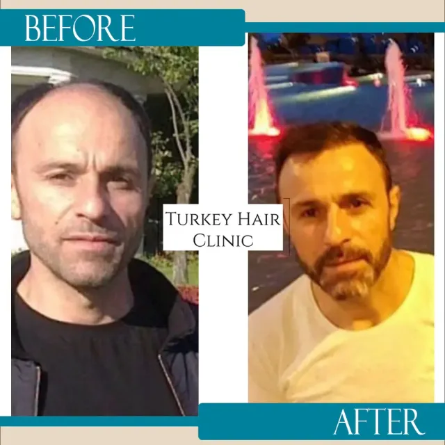 Hair transplant before and after collage — Turkey Hair Clinic, result 3