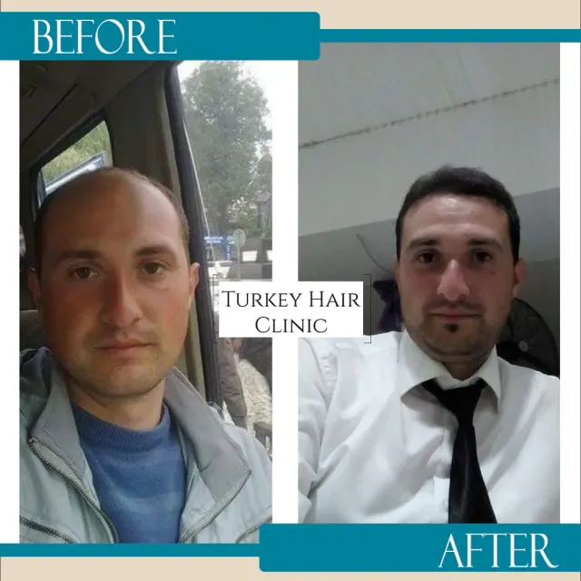 Hair transplant before and after collage — Turkey Hair Clinic, result 10