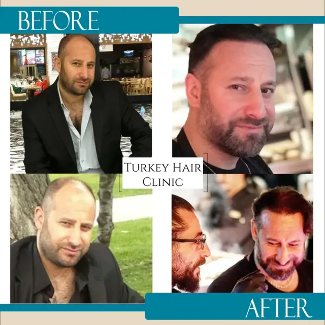 Hair transplant before and after collage — Turkey Hair Clinic, result 12