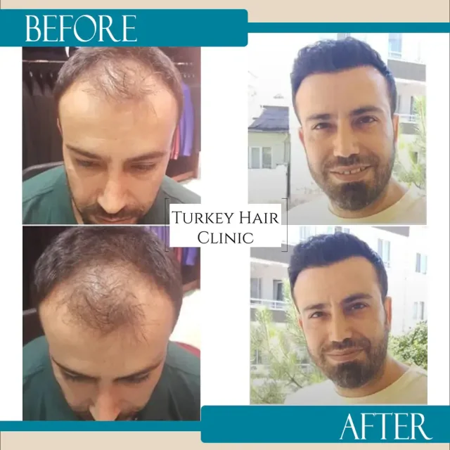 Hair transplant before and after collage — Turkey Hair Clinic, result 14