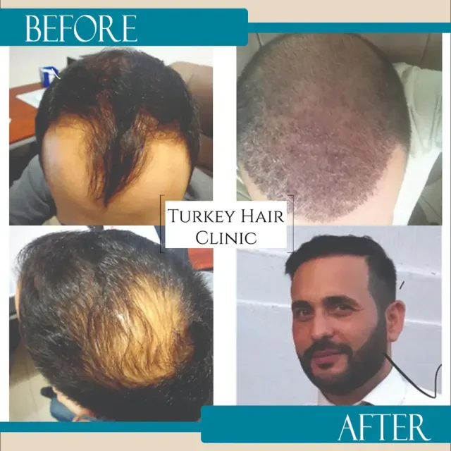 Hair transplant before and after collage — Turkey Hair Clinic, result 21
