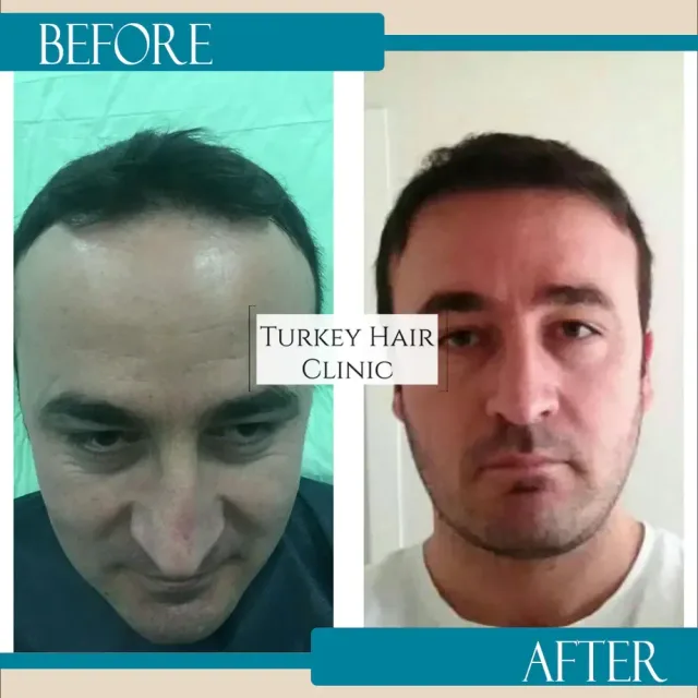 Hair transplant before and after collage — Turkey Hair Clinic, result 23