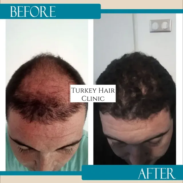 Hair transplant before and after collage — Turkey Hair Clinic, result 24