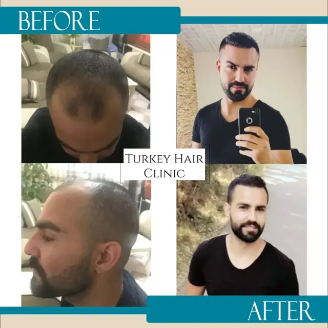 Hair transplant before and after collage — Turkey Hair Clinic, result 31