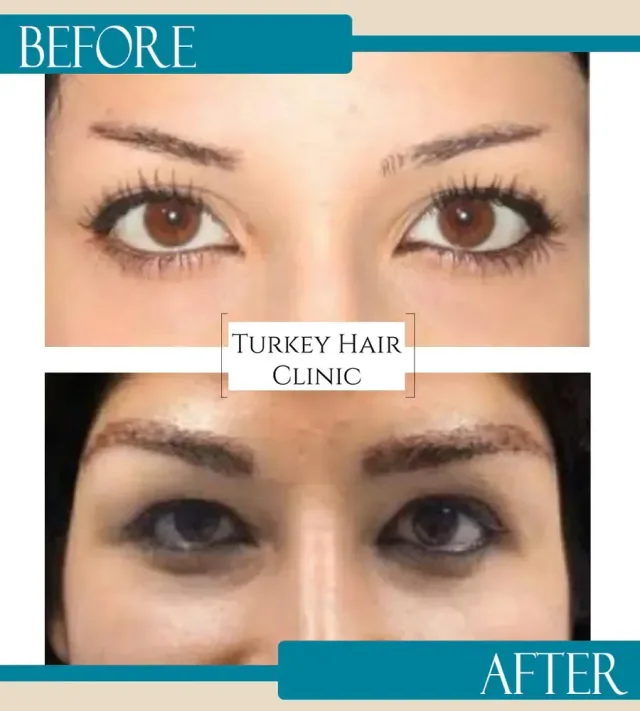 Hair transplant before and after collage — Turkey Hair Clinic, result 32