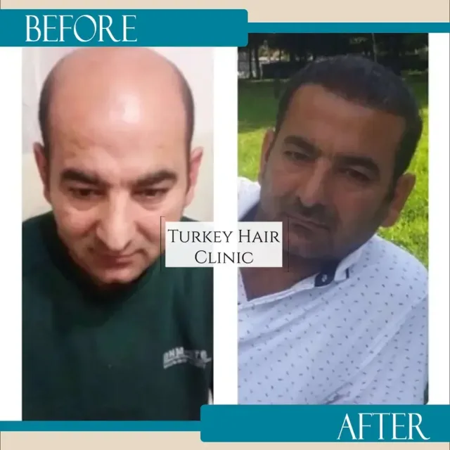Hair transplant before and after collage — Turkey Hair Clinic, result 41