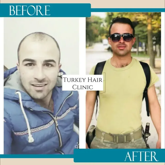 Hair transplant before and after collage — Turkey Hair Clinic, result 45