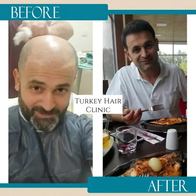 Hair transplant before and after collage — Turkey Hair Clinic, result 49