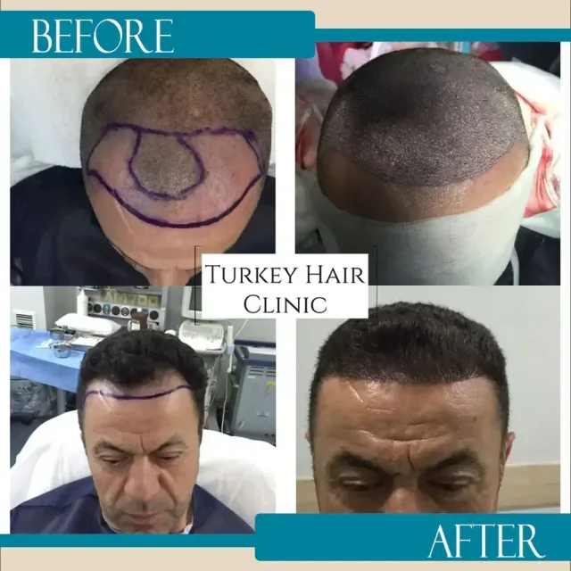 Hair transplant before and after collage — Turkey Hair Clinic, result 54