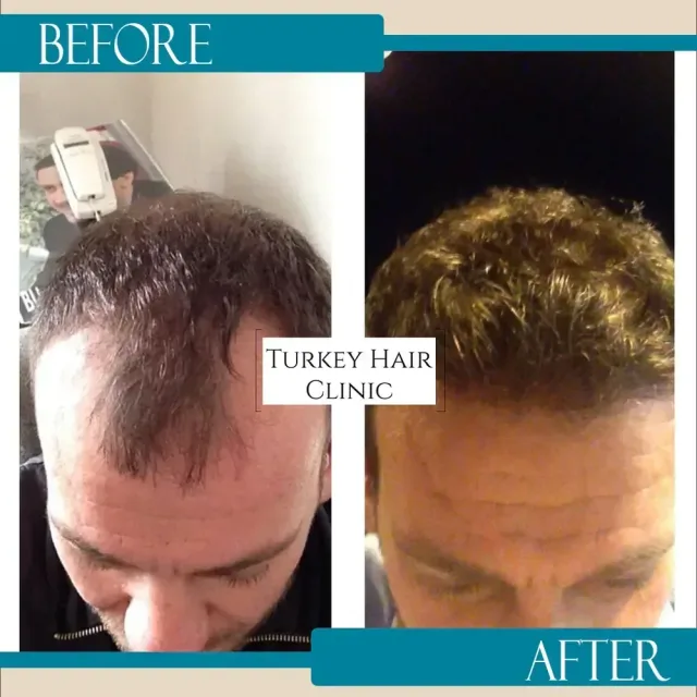 Hair transplant before and after collage — Turkey Hair Clinic, result 59