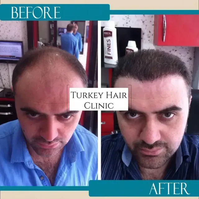 Hair transplant before and after collage — Turkey Hair Clinic, result 66