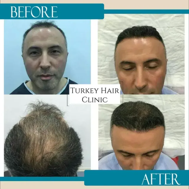 Hair transplant before and after collage — Turkey Hair Clinic, result 68